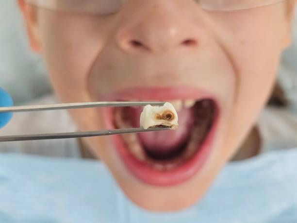 Best Emergency Tooth Extraction in Eaton, OH